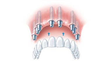 Implantate