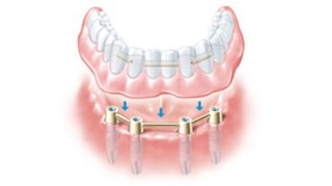 Implantate